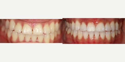 25-34 year old woman treated with Zoom Whitening - This patient desired whiter teeth. Zoom Teeth Whitening was used to achieve brighter, whiter teeth. Patient was very happy with results.