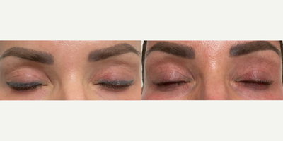 55-64 year old woman treated with Tattoo Removal - Tattoo removal for eyeliner, results shown are 2 months after the patient's fifth session. She has one more session scheduled.