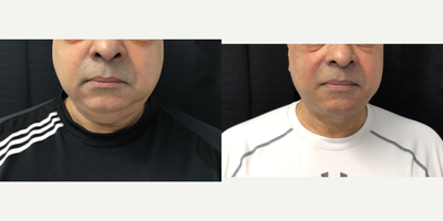 65-74 year old man treated with CoolMini - 67 year old male. Six weeks after one treatment of three cycles of the CoolMini.