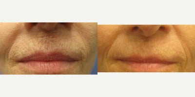 65-74 year old woman treated with Microdermabrasion - 72-year-old female before and 6 months after one deep Microneedling session to her upper lip. Microneedling device has different depths/settings and the deepest one the patient will not tolerate without local anesthesia, which this patient had before her session. This allows a more aggressive treatment. There's minimal downtime with some redness for the first few days.