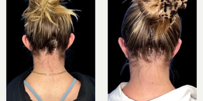 Woman treated with Ear Surgery - My patient is loving the results of her otoplasty just 2 months post-op. An otoplasty can reduce the appearance of overly large or protruding ears for patients.