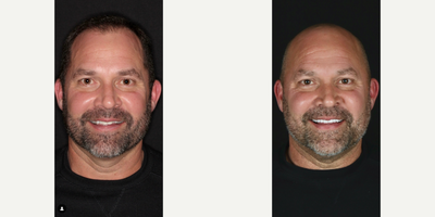 Man treated with Smile Makeover, Dental Implants - Smile makeover completed with a dental implant front and center!Shade: BL2 HT