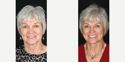Woman treated with Smile Makeover, Porcelain Veneers, Dental Crown - My teeth dont whiten like they used to!Clenching and grinding can create micro-fractures in the teeth. These fractures are small enough that things like coffee, tea, red wine, tobacco, and even chromogenic bacteria can permeate deeply and make whitening less effective.One of the many perks of porcelain veneers-they dont stain!Treatment: 10 porcelain veneersShade: BL1/BL2 HT