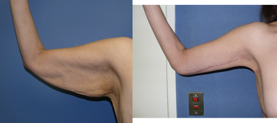 45-54 year old woman treated with Arm Lift - After massive weight loss, an arm lift, also called brachioplasty&nbsp;