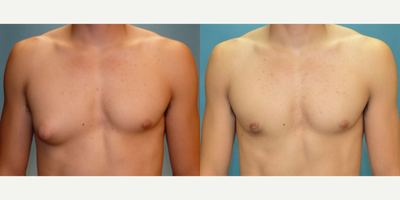 18-24 year old man treated with Male Breast Reduction - Gynecomastia - In this case, it's unilateral, just on the right.  More often it's two sided. Besides removing the breast tissue, we needed to relocate and reduce the size of the nipple/areola complex.