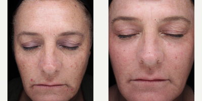 Woman treated with Renuvion - Woman treated with Renuvion