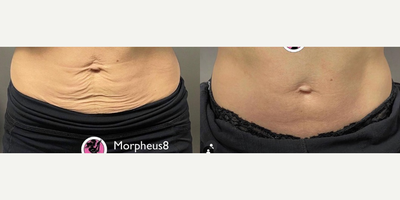 Woman treated with Microneedling RF - Woman treated with Microneedling