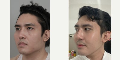 25-34 year old man treated with Cheekbone Reduction, V Line Surgery - .