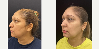45-54 year old woman treated with FaceTite - Chin and neck liposculpting, facetite