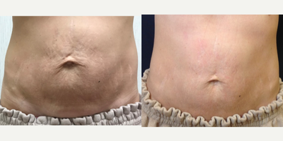 35-44 year old woman treated with Titan Laser - One treatment is beneficial but most patients choose our package of 4 for optimal results. Each additional treatment is scheduled 4-6 weeks from the prior treatment. Titan is an ideal solution, without surgery, recovery time, or injections.