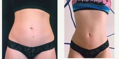 35-44 year old woman treated with Emsculpt - Emsculpt