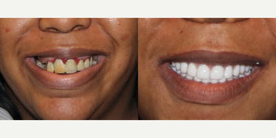 All-on-4 Dental Implants - All-on-4 Dental Implants