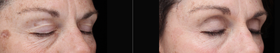 45-54 year old woman treated with Halo Laser - After 1 Halo Treatment