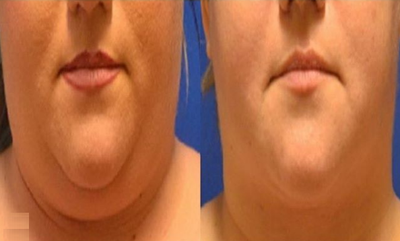 Woman treated with ThermiSmooth Face - Woman treated with ThermiSmooth Face