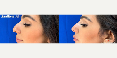 Woman treated with Nonsurgical Nose Job - Woman treated with Nonsurgical Nose Job