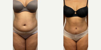 45-54 year old woman treated with Tummy Tuck - Before and 10 months after an abdominolasty with muscle tightening10