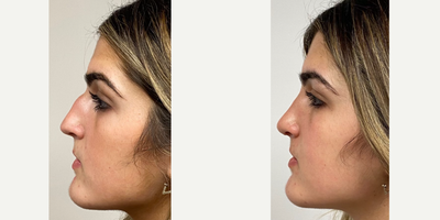 18-24 year old woman treated with Rhinoplasty - 15 Days after a Rhinoplasty.