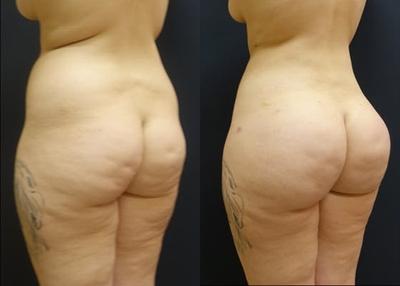 25-34 year old woman treated with Butt Augmentation - The patient underwent a Brazilian Butt Lift (butt augmentation with fat transfer) to enhance her butt and transform her shape! The combination of the liposculpting and fat transfer gives her an hour glass figure. She had 1200cc of fat transferred to each butt and hip dip area.