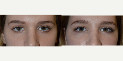 18 year old female, before/after lower eyelid retraction surgery, tear trough implant--> almond eyes - 18 year old female with inherited lower eyelid retraction, sclera show and under eye hollowness, with sad looking eyes.  She underwent lower eyelid retraction surgery, canthoplasty, and tear trough implants. Note more attractive almond shape eyes.