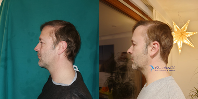 35-44 year old man treated with Cheek Implants - For lower infection risk versus an intraoral approach, implants were placed transconjunctivally and were fixated with two screws to avoid implant mobilization risk.