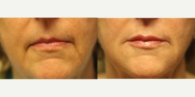 55-64 year old woman treated with Restylane - Filler was placed in lips and marrionette lines. No flash photography was used on  before or after photos