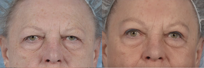 Browplasty (brow lift) with blepharoplasty (eyelid lift) - Browplasty with blepharoplasty to improve upper eyelid hooding and brow ptosis (droopy brows). There is a well-concealed upper eyelid incision and a trichophytic (within the hairline)brow incision. A trichophytic brow incision allows hairs to grow through the scar, allowing for excellent camouflage.