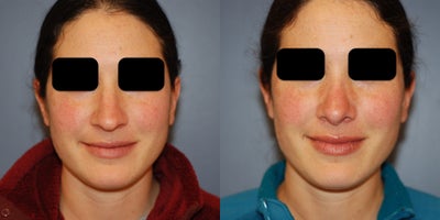 25-34 year old woman treated with Rhinoplasty - 25-34 year old woman treated with Open Rhinoplasty