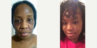 Rejuvenation after Face Fat Fill: The modern facial plastic surgery complement - As the left picture shows this patient had very accent static facial wrinkles and facial dehydration under the eyelids, naso-labial folds and checks, making her a good candidate for autologous fat transfer to these facial areas.The fat was obtained performing Full Body Intense liposuction of the belly, back, waist and flanks areas.Was transferred 100cc of previously prepared fat to the face in total.