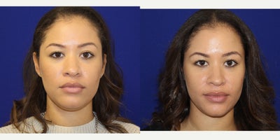 25-34 year old woman treated with Chin Liposuction - 31 yo female complaining of fullness under the chin, she had tried Kybella but it didnt work as well as she had hoped. She underwent neck and jawline liposuction, without general anesthesia. Here she is 3 weeks afterwards with a more contoured neck and jawline.