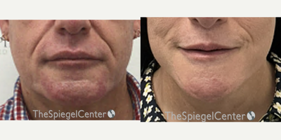 55-64 year old transgender woman treated with Facial Feminization Surgery - 55-64 year old transgender woman treated with Facial Feminization Surgery