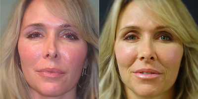 Rhinoplasty - Rhinoplasty