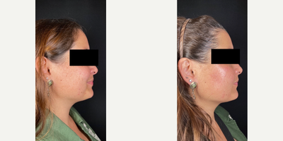 25-34 year old woman treated with Neo Laser - This patient had amazing results with the following treatments:- RX Clear and Brilliant, 2 sessions- NeoAeolase Melasma, 3 sessions