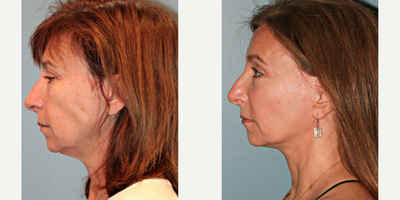 61 year old woman treated with Blue Peel - This patient underwent a Blue Peel, LiteLift, upper and lower eyelids, and fat transfer to cheeks. She had little bruising or swelling at 3 weeks post-op, which is one of the many benefits of our LiteLift facelift procedure. Results are also very natural as you can see in her pictures. After photos were taken 9 months post-op.