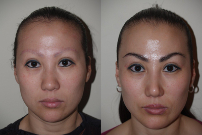 Rhinoplasty, Jawline Liposuction, and Eyebrow Grafts - Before and 8 months after rhinoplasty and liposuction along jawline and upper blepharoplasty, as well as eyebrow transplant. This Korean patient desired a more prominent projected and refined nose, along with more visible upper eyelids and defined jawline. She also had prior tattoo and subsequent scarring to the eyebrows, which was successfully treated with an eyebrow transplant of 500 grafts.