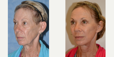 65-74 year old woman treated with Facelift - Facelift with Fat Transfer, Upper and Lower Blepharoplasty, Peri-Oral Erbium Laser