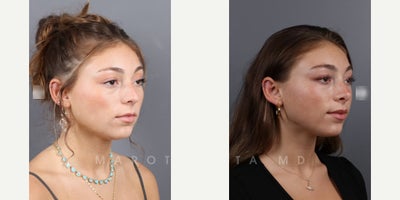 Woman treated with Septoplasty - Woman treated with Septoplasty