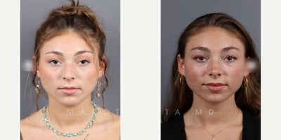 Woman treated with Septoplasty - Woman treated with Septoplasty