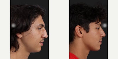 Man treated with Septoplasty - Man treated with Septoplasty