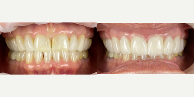55-64 year old woman treated with Da Vinci Veneers, Porcelain Veneers - Female patient wanted to change her smile a while ago, she was hesitant to make the decision, but after a comprehensive dental evaluation and a digital smile design visit, we were able to listen to her concerns and her expectations, we built a couple of proposals and she decided to start the process of her new smile. She wanted to replace old composite restorations that were stained and chipped, and she also had loss of enamel due to wear. We restore her smile with minimally-invasive veneers, and hand crafted veneers (Da Vinci Veneers) by our ceramist. She absolutely loved the results and she is very happy and confident to smile again!.