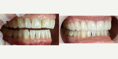 55-64 year old woman treated with Da Vinci Veneers, Porcelain Veneers - Female patient wanted to change her smile a while ago, she was hesitant to make the decision, but after a comprehensive dental evaluation and a digital smile design visit, we were able to listen to her concerns and her expectations, we built a couple of proposals and she decided to start the process of her new smile. She wanted to replace old composite restorations that were stained and chipped, and she also had loss of enamel due to wear. We restore her smile with minimally-invasive veneers, and hand crafted veneers (Da Vinci Veneers) by our ceramist. She absolutely loved the results and she is very happy and confident to smile again!.