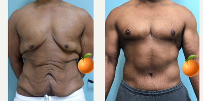 18-24 year old man treated with Male Tummy Tuck and gynecomastia surgery - full upper and lower body lift with nipple grafts.