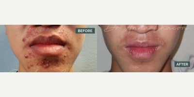 Man treated with Accutane - Achieving clear, healthy skin on Accutane is a journey with ups and downs, but seeing these results is so rewarding.