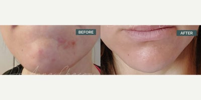 Woman treated with Accutane - Woman treated with Accutane