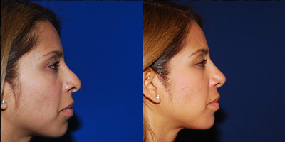 Revision Rhinoplasty - 
	Revision Rhinoplasty
