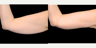 35-44 year old woman treated with Exilis - Patient was received a 4 treatment package with the Exilis Ultra and had great results. Photos were taken a little over a month apart.