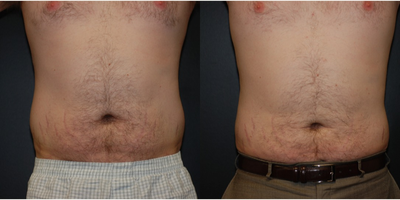 25-34 year old man treated with Liposuction - Four months after trunk liposuction in a male patient