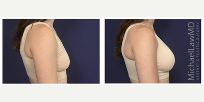 35-44 year old woman treated with Ideal Implant - Breast augmentation. Follow-up photo taken 3 months after the procedure.