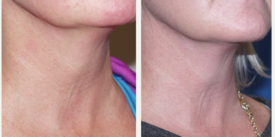 Micro-Botox for Neck Rejuvenation - Micro-Botox is a wonderful technique to rejuvenate the neck skin. Micro amounts of Botox are placed within the skin to smooth, shape and tighten the neck skin. Note the bulge under the chin has also improved.