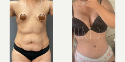 Woman treated with Tummy Tuck, Lipo 360 - Woman treated with Tummy Tuck, Lipo 360