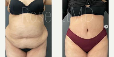 Woman treated with Lipo 360 - Woman treated with Lipo 360